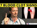 7 Warning Signs Of A BLOOD CLOT Symptoms 2026