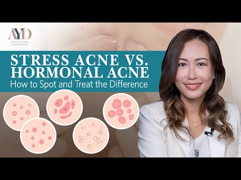 Stress Acne vs. Hormonal Acne: How to Spot and Treat the Difference