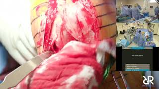 Dr. Stefan Kreuzer performs Total Knee Arthroplasty using the Think Surgical Robot | TCAT.