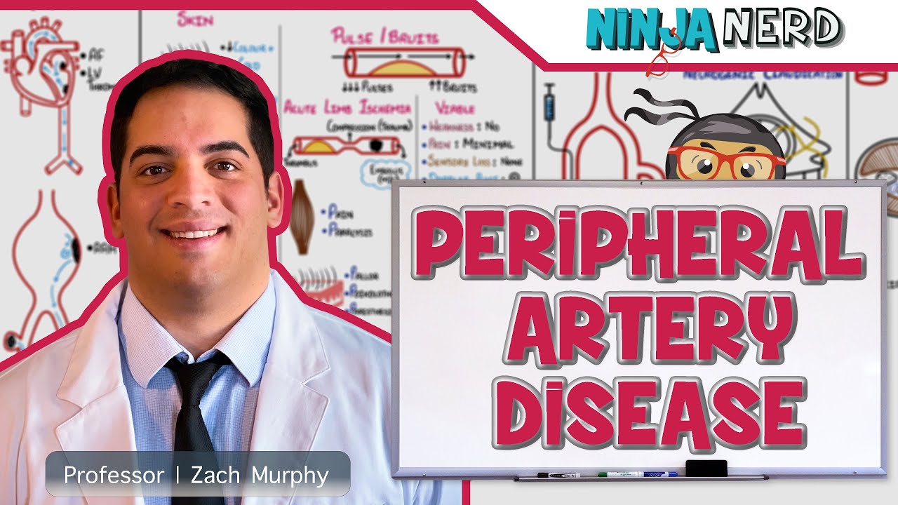 Peripheral Artery Disease | Retired