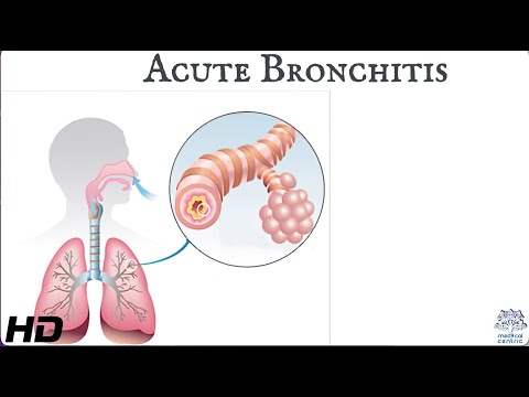 Acute bronchitis: Everything You Need To Know