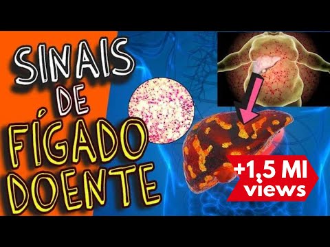 SINTOMAS QUE SEU FÍGADO PODE NÃO ESTAR BEM (esteatose hepática e cirrose)