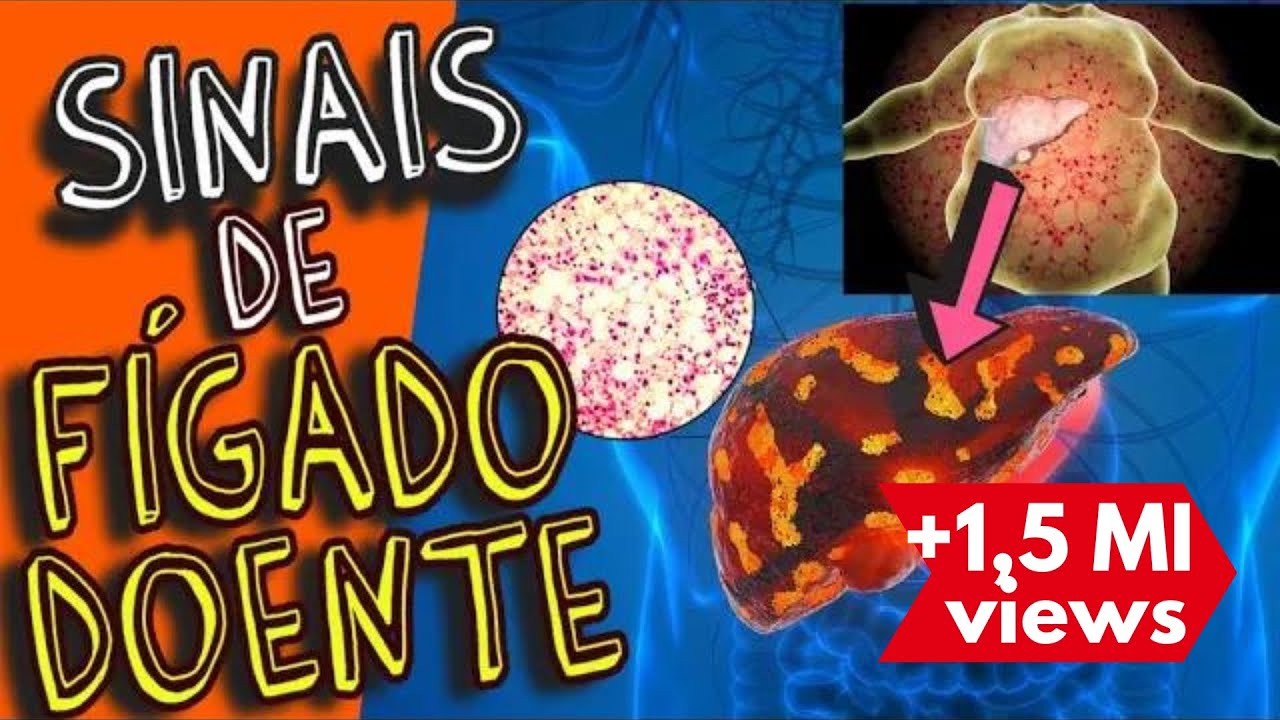 SINTOMAS QUE SEU FÍGADO PODE NÃO ESTAR BEM (esteatose hepática e cirrose)