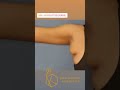 Single Keyhole Incision Armpit Tissue Removal Axillarybreastisuueremoval Shorts