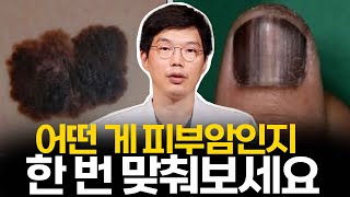 이 둘 중 어떤 게 피부암인지 맞춰보세요 이게 피부에 있다면 당장 병원 가야 합니다 #피부암