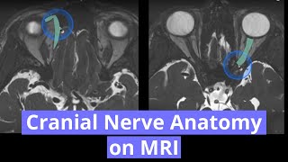 Download lagu Cranial Nerve Anatomy on MRI mp3