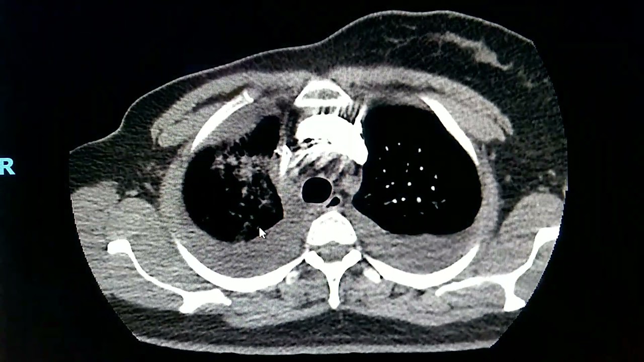 Trombo Embolismo Pulmonar - TEP . Tomografia de TEP , Você sabe como Fazer?