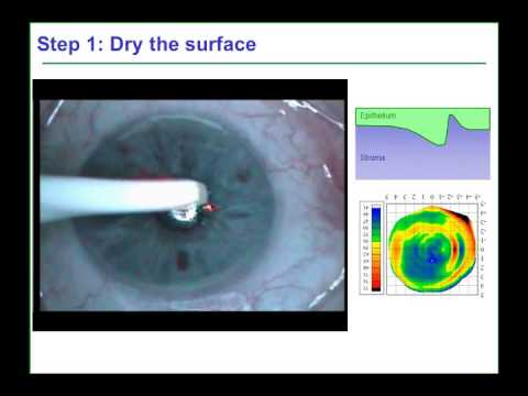 Trans-epithelial phototherapeutic keratectomy for repair of refractive surgery complications