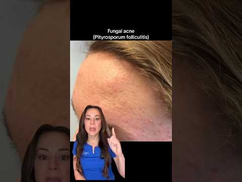 Use THIS Not THAT: Fungal Acne — From A Derm | #shorts #skincare |