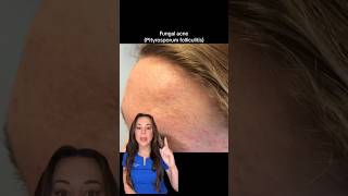 Download lagu Use THIS Not THAT: Fungal Acne — From A Derm | #shorts #skincare | mp3