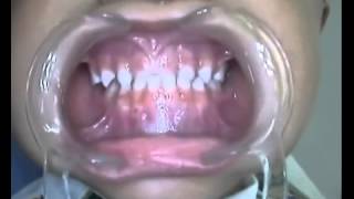 Pista Direta para Mordida Cruzada Anterior