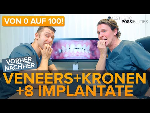 8 Implantate / 6 Veneers / 10 Zirkon Keramikkronen - Kompletter Fall, krasser vorher/nachher Effekt