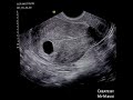 Early pregnancy showing gestational sac without yolk sac or embryonic node | ultrasound