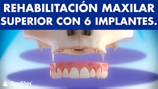 Maxilar superior - Rehabilitación del maxilar con 6 implantes ©  - Clínica Dental Pardiñas