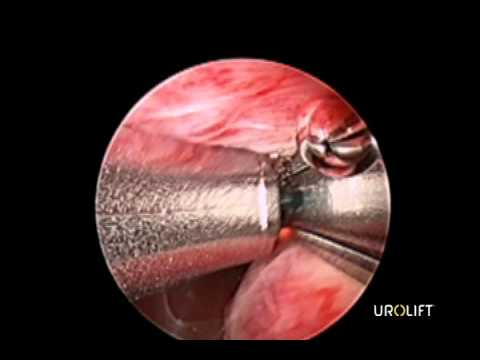 Nach dem Trinken von Prostatitis Wie auch die Operation der Prostata-Adenom zu entfernen