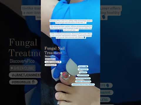 onychomycosis fungal Toenails with Laser Treatment