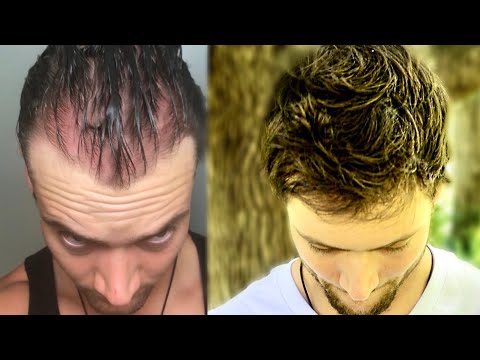 How I Quit The World’s Best Hair Loss Treatment and Regrew My Hair Naturally | Connor Murphy
