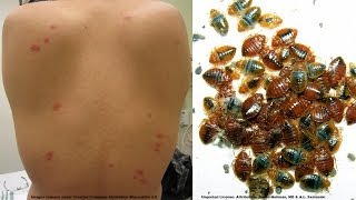 How To Find Out If You Have Bed Bugs Discreetly - Surge Protector Bed Bug Trap Review