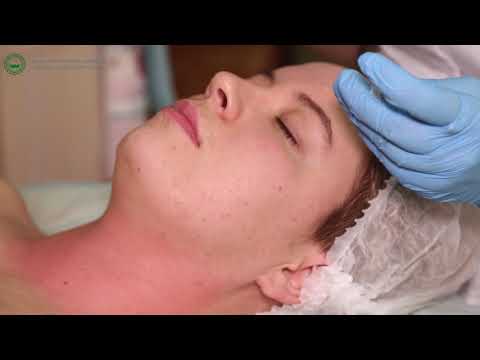 Эстетическое ремоделирование кожи (фракционная мезотерапия + пилинг SuNVipeel)