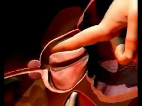 Il cancro alla prostata flutamide e Candele con Perm prezzo prostatilenom