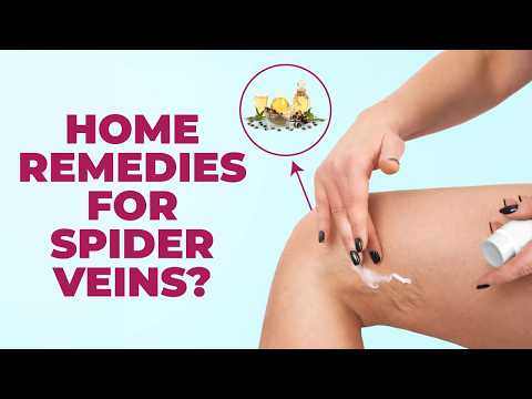 Do Natural Remedies Work for Spider Veins? | Home Remedies to Treat Spider Veins