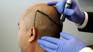 Can you Have Hair Transplant? | Hair Transplant Dubai Clinic