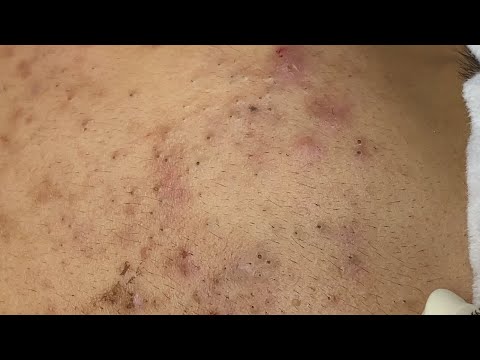 Blackhead Removal: Satisfying Skin Transformation!