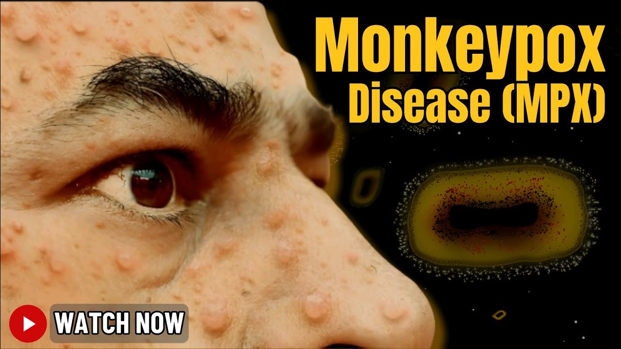 Monkeypox Disease (Mpox): Complete Guide to Symptoms, Causes, & Prevention | Latest News & Updates