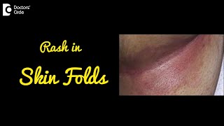 INTERTRIGO | Rash in Skin Folds | Causes, Symptoms, and Treatment - Dr.Nischal K C | Doctors