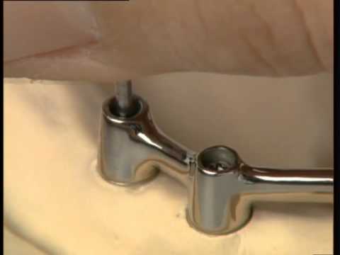 Этапы работы зубного техника по изготовлению балочной конструкции на имплантатах