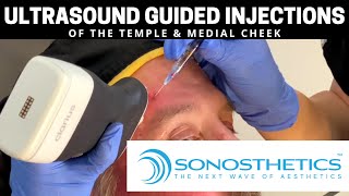 Ultrasound Guided Injections Of The Temple & Medial Cheek