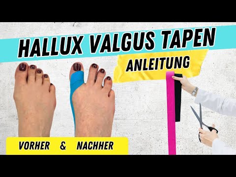 HALLUX VALGUS TAPEN ANLEITUNG | So kannst du einen HALLUX VALGUS TAPEN!