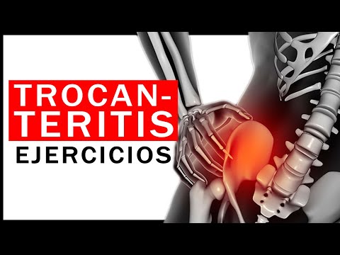 Trocanteritis 🤷♂️🤯 trátalo conmigo!