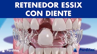 Retenedor ESSIX con diente - Una solución provisional para los DIENTES FALTANTES ©