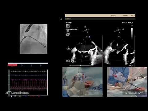 Mitralclip For Severe MR In A Frail Patient