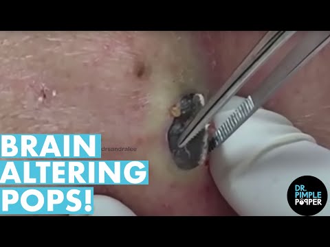 The POPS That Altered My Brain Chemistry! 20 Minutes! Dr Pimple Popper Best Of