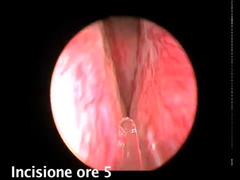 Proteina C reattiva per la prostata Aborto spontaneo in prostatite marito