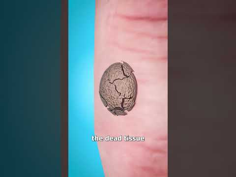 How Warts Are Frozen Off 🥶