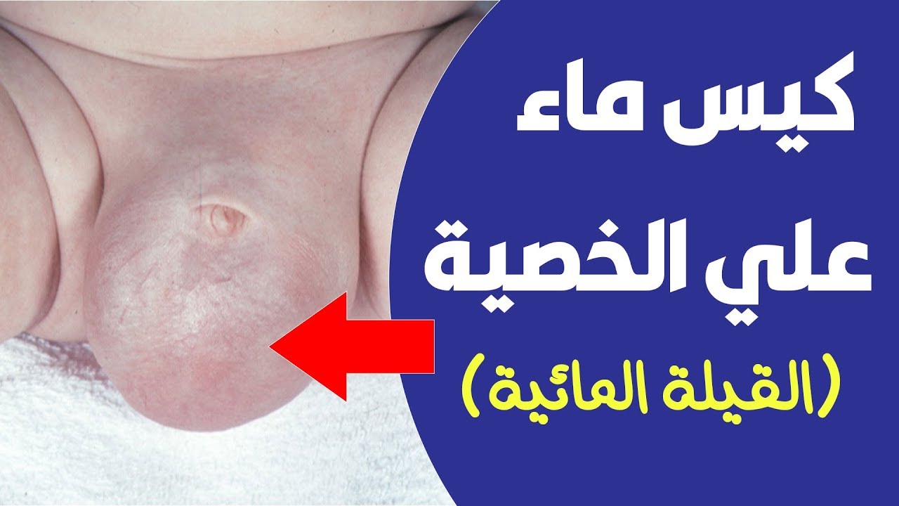 اسباب انتفاخ الخصية عند الاطفال 👈 كيس ماء علي الخصية (القيلة المائية)