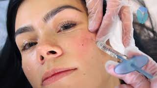 Aplicación de Ácido Hialurónico con Voluma de Júvederm por la Dra. Claudia García