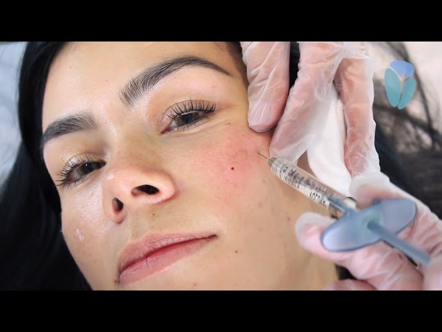 Vídeo relacionado con Kefus Viales Triple Ácido Hialurónico 10x5ml | Con Niacinamida y Pantenol | Efecto Relleno y Tensor | Antiedad | No Inyectable