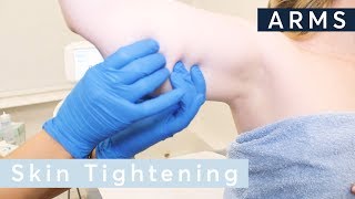 Skin Tightening Arms - HIFU Ultraformer III Treatment
