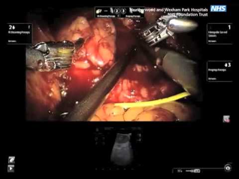 Occlusion Angiography Using Intraoperative Contrast-enhanced Ultrasound Scan (CEUS)