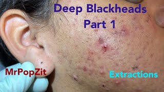 Deep waxy pore plugs removed. 20 minutes of extractions with MrPopZit.