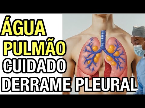 Water in the lungs? Understand what pleural effusion is and how to treat it.