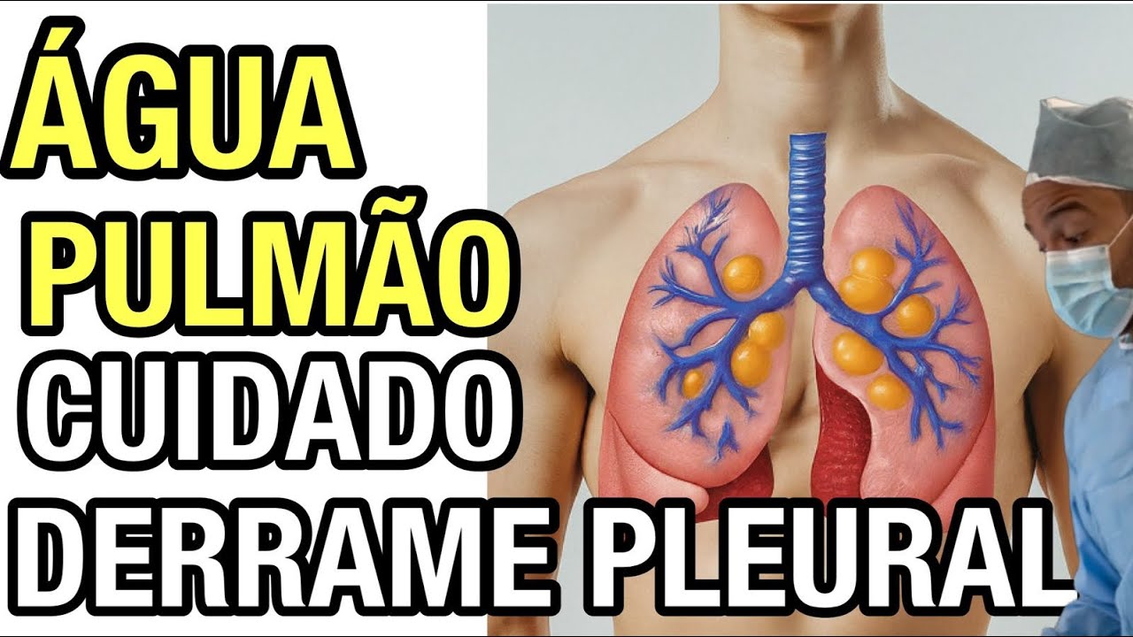 Água no pulmão? Entenda o que é o derrame pleural e como tratá-lo