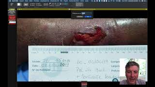 Medida de Área de Úlcera