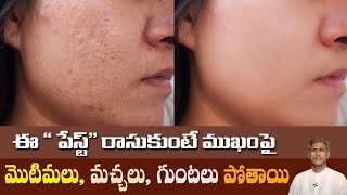 Remove Pimples and Acne Scars by Homemade Face Pack | Dark Spots | Dr. Manthena