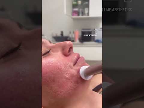 Micro-channeling •Virtually no downtime•Improves the appearance hyper pigmentation •Improves scars✨