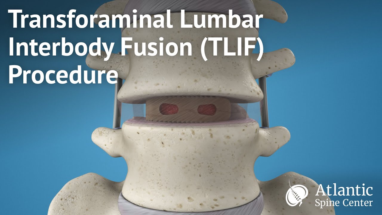 Transforaminal Lumbar Interbody Fusion (TLIF) Procedure